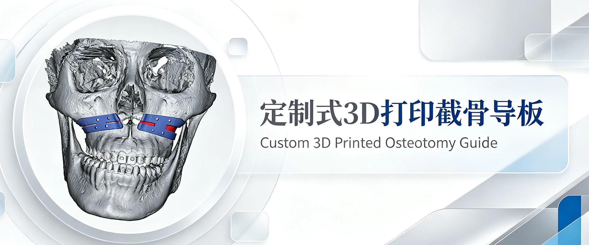 定制式3D打印截骨导板2